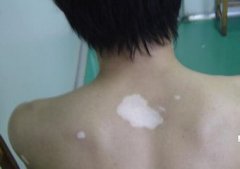白癜风的饮食要求什么呢
